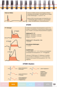 STEMI